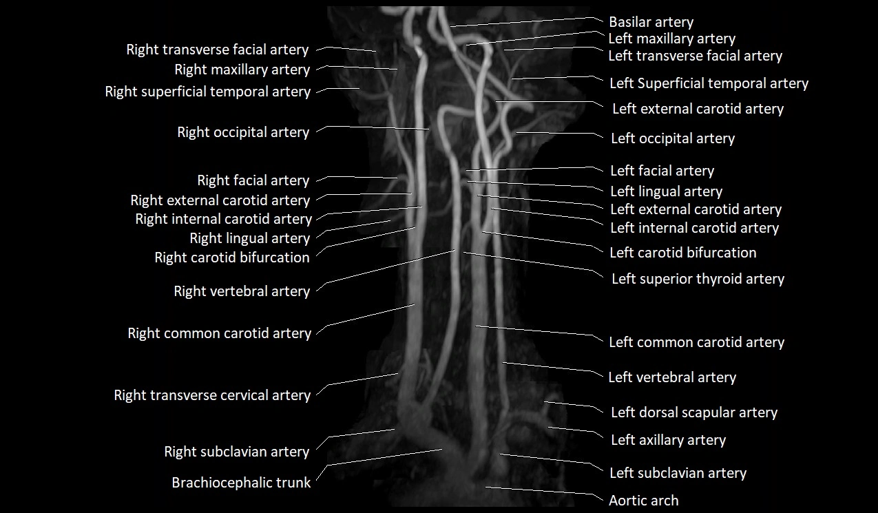 MRA neck carotid arteries labeled anatomy image MIP 3D image 2.webp